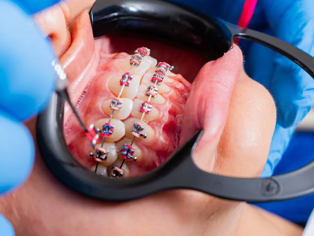 Tratamiento de ortopedia funcional en Dental Stocks